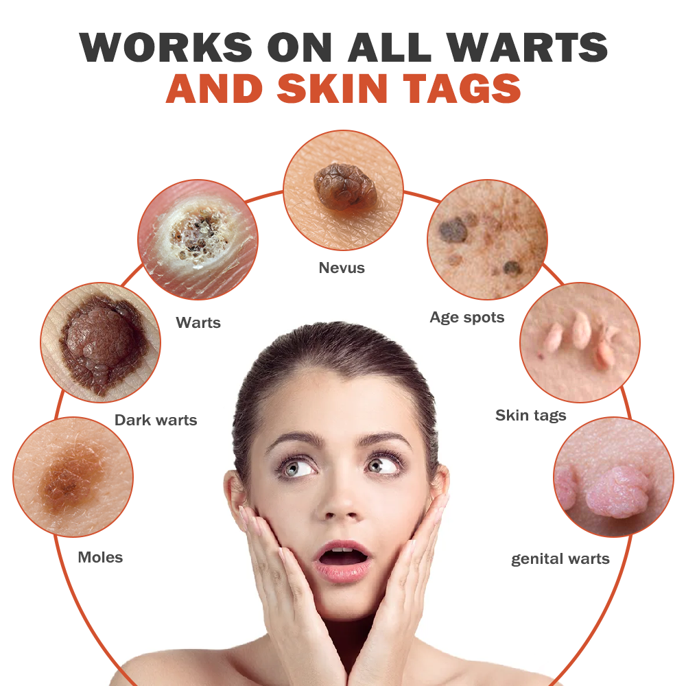 🐝🐝[✨𝐎𝐟𝐟𝐢𝐜𝐢𝐚𝐥 𝐁𝐫𝐚𝐧𝐝 𝐒𝐭𝐨𝐫𝐞✨] 𝐙𝐨𝐞𝐧𝐜𝐠𝐳™™ 𝐁𝐞𝐞 𝐕𝐞𝐧𝐨𝐦 𝐌𝐨𝐥𝐞 𝐚𝐧𝐝 𝐖𝐚𝐫𝐭 𝐓𝐫𝐞𝐚𝐭𝐦𝐞𝐧𝐭 𝐂𝐫𝐞𝐚𝐦(👨‍⚕𝐀𝐀𝐃 𝐑𝐄𝐂𝐎𝐌𝐌𝐄𝐍𝐃𝐒)