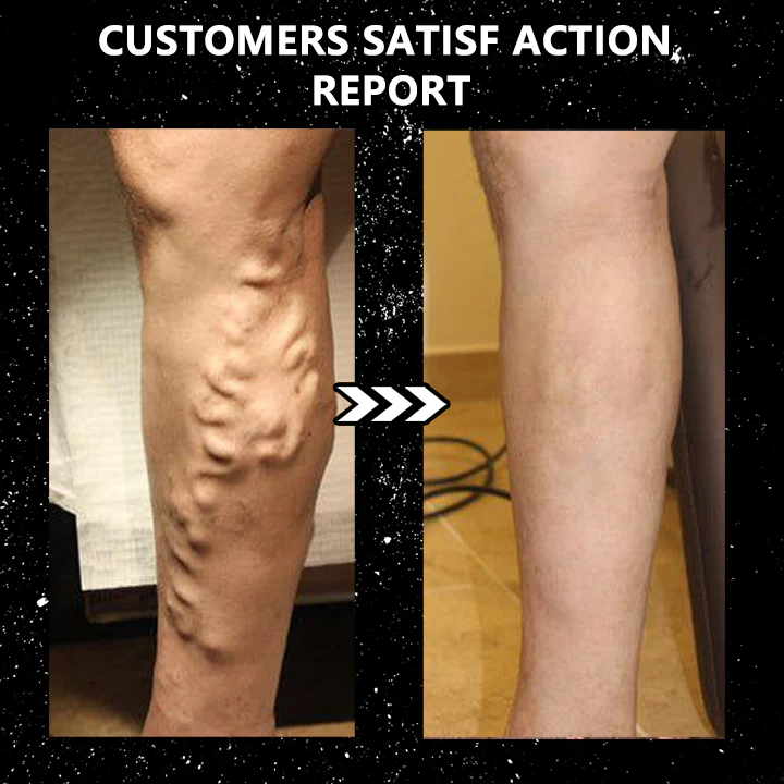 🇺🇲𝑶𝒇𝒇𝒊𝒄𝒊𝒂𝒍 𝑺𝒕𝒐𝒓𝒆 |🔥🦵FROCCHAR® Tourmaline Slimming & Varicose Veins & Detoxification Stretch Socks （Results in 7 days）✅For obesity,Joint pain, lymph nodes, varicose veinsas, and more